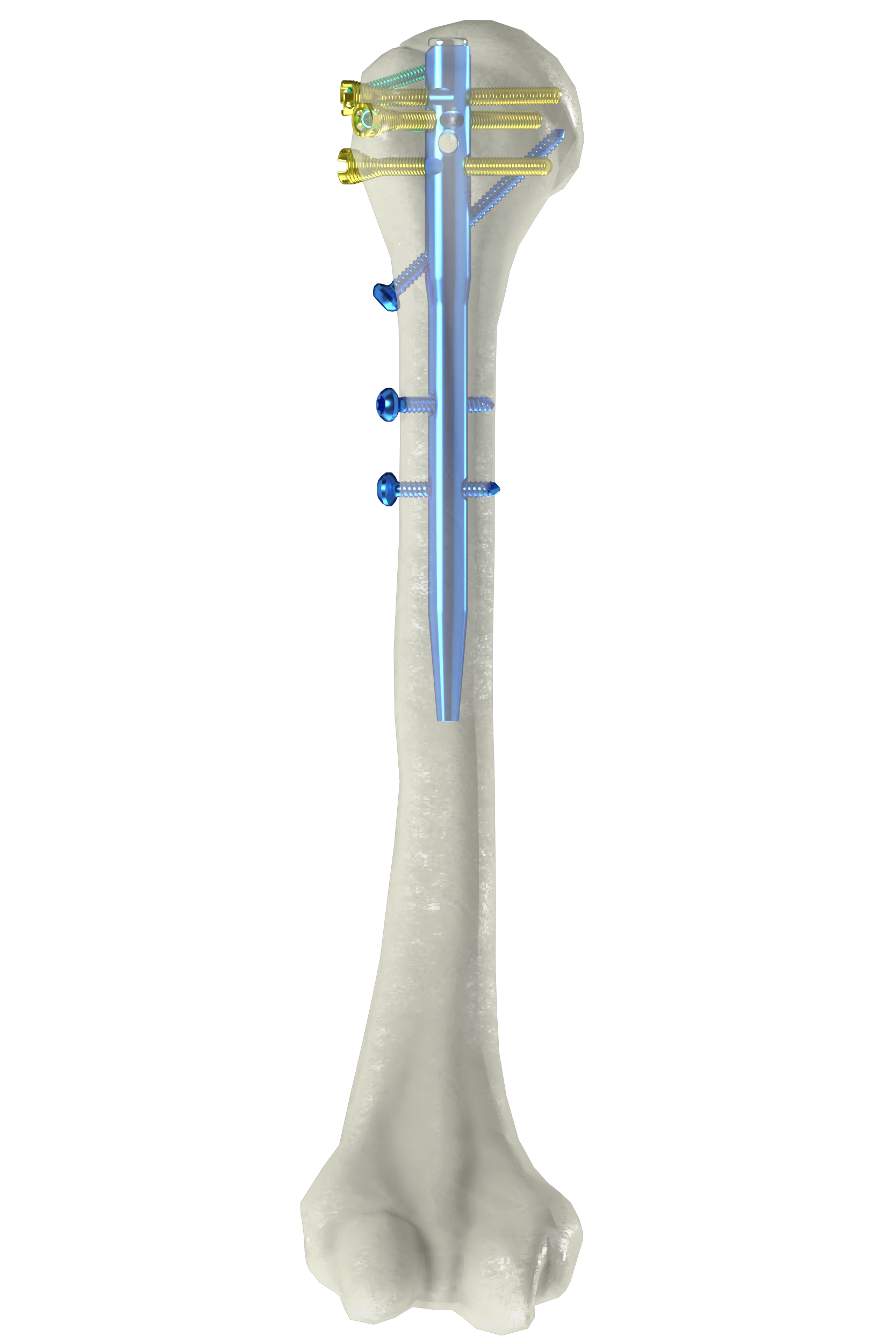 肱骨髓内钉（NH-05）