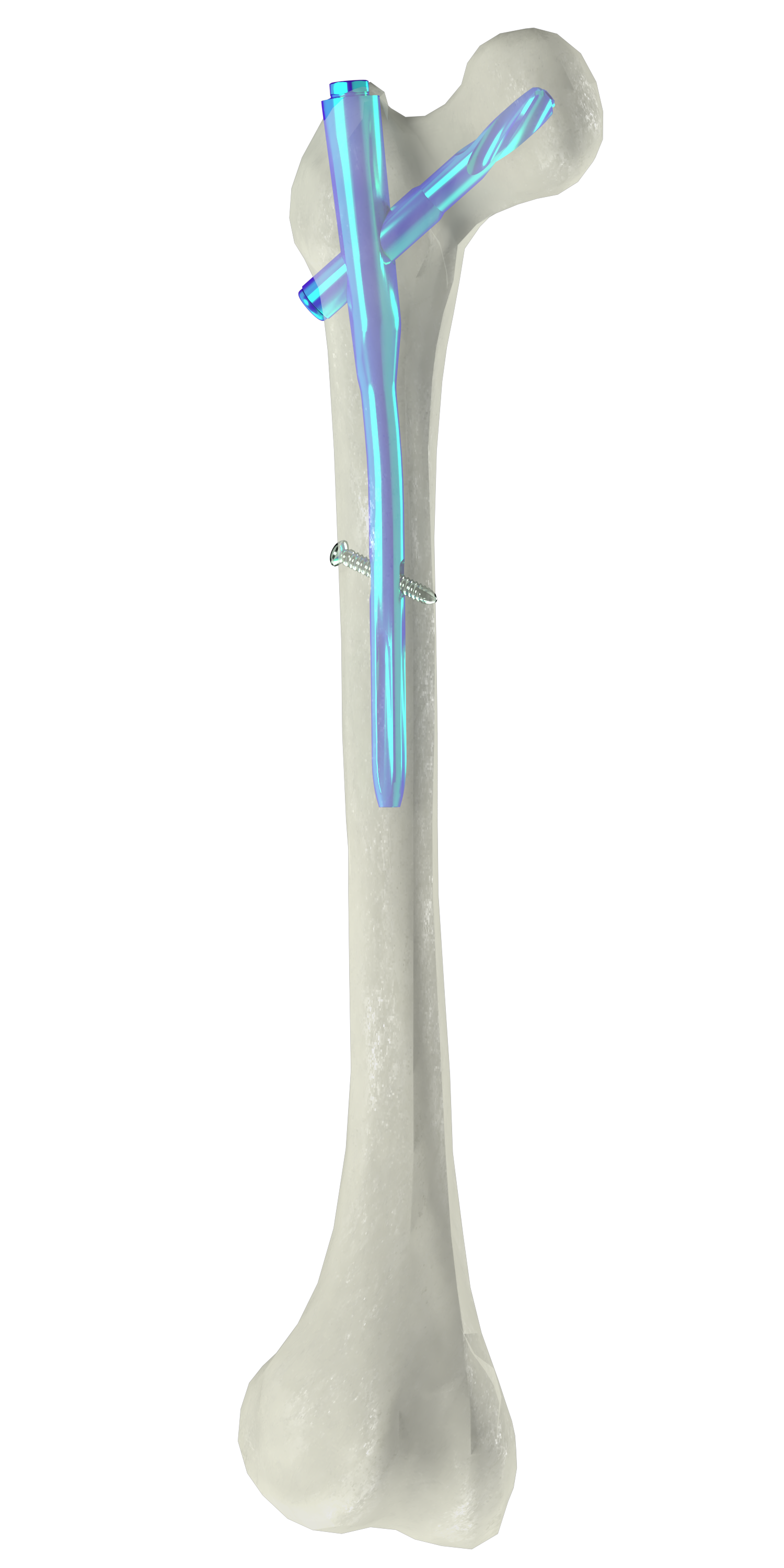 股骨髓内钉（NF-01）