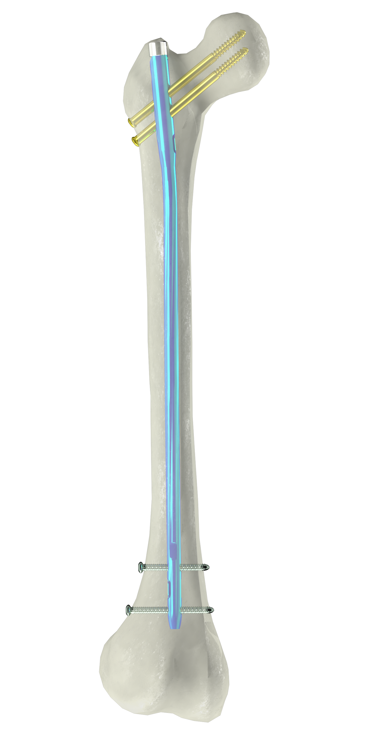 股骨髓内钉（NF-05）